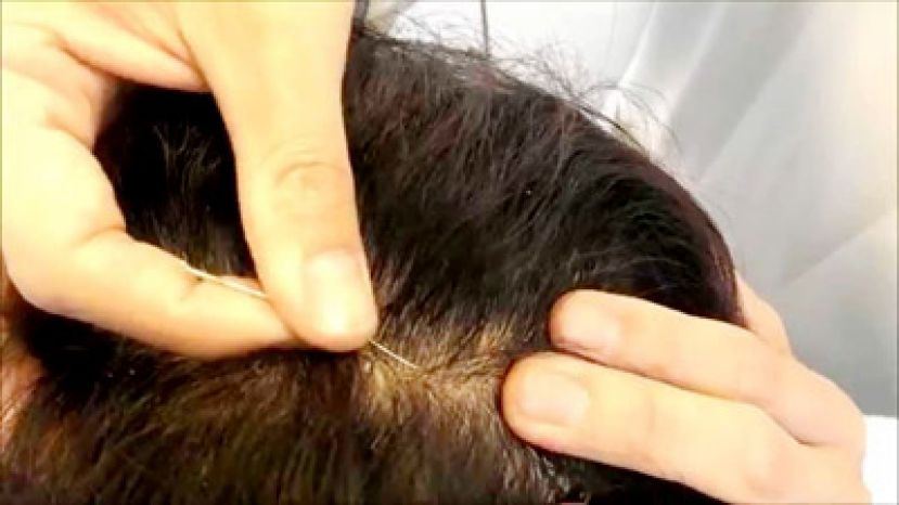 失智症无药可治？中医针灸让大脑重开机