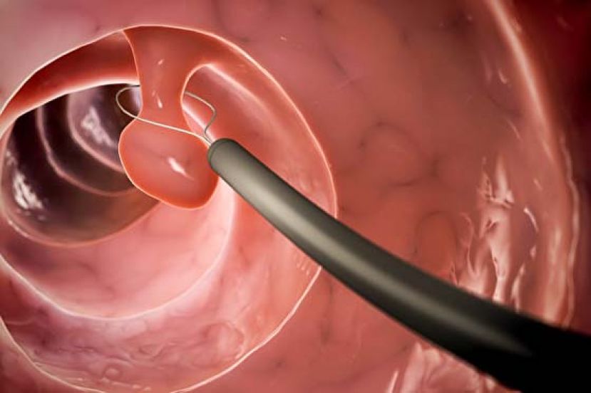 做大肠镜找病征　如何清肠更重要