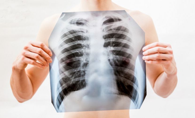 41岁男不烟竟肺癌 免疫治疗病况稳