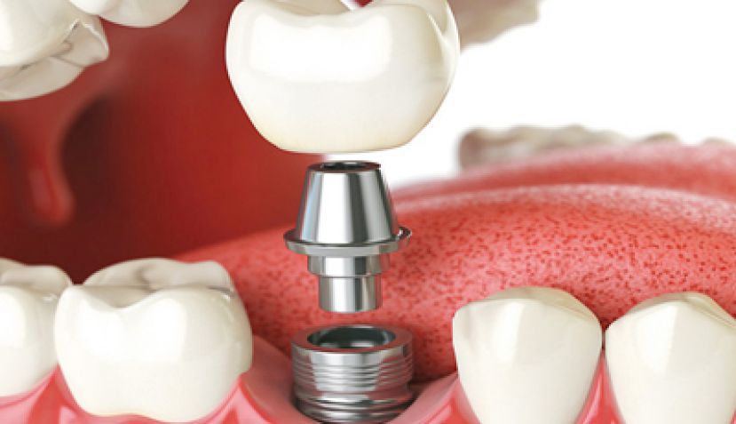 担心植牙不成功？&ldquo;数位导板&rdquo;辅助降风险