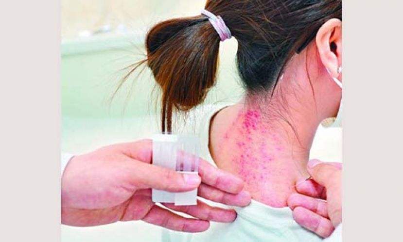 维持同一姿势积劳成伤 刮痧针灸治低头族僵硬肌