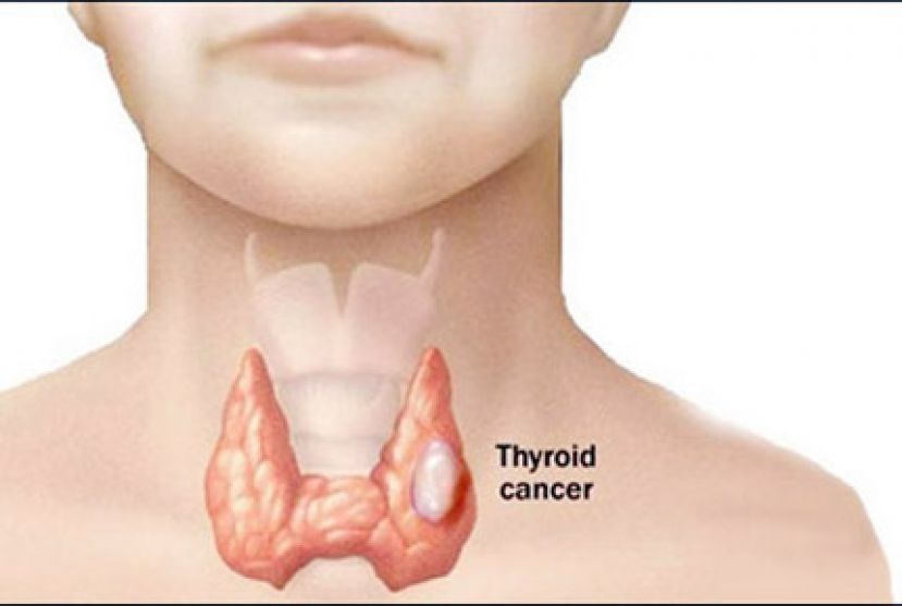 脖子肿块会长大！甲状腺癌5危险因子
