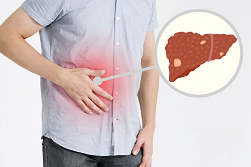 肝癌元凶竟是它 唤醒健康&ldquo;护肝&rdquo;有撇步