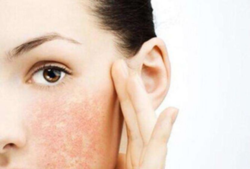 脸严重过敏泛红 恐是毛囊蠕形虫作祟