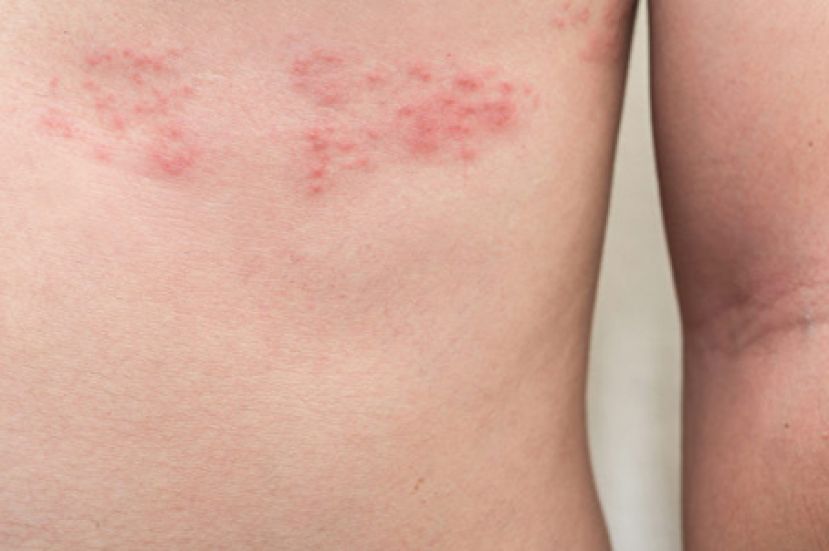 免疫差易发作 二招预防带状疱疹