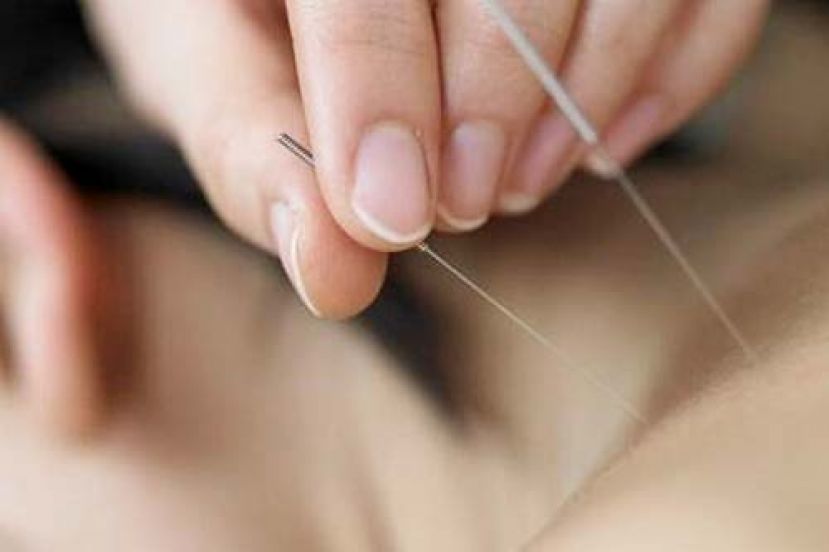 多年颈椎痛并手麻  针灸并复健可减缓