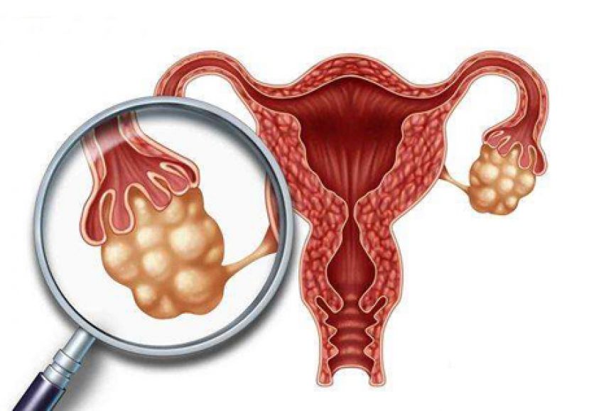 多囊性卵巢症候群 罹糖尿病机率增十倍