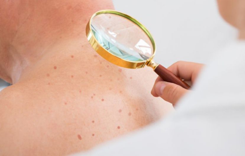 免疫治疗击退皮肤癌复发噩梦 近九旬嬷符资格没在怕