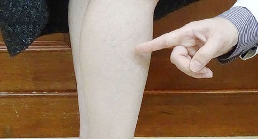 双脚变肿、变黑　竟因静脉曲张引起