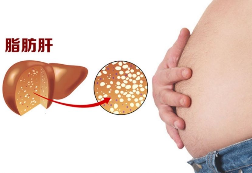 4成民众有脂肪肝 健康减重为解方