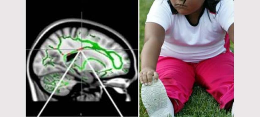 痴肥儿童脑部损害大 研究：影响情绪控制专注力变差