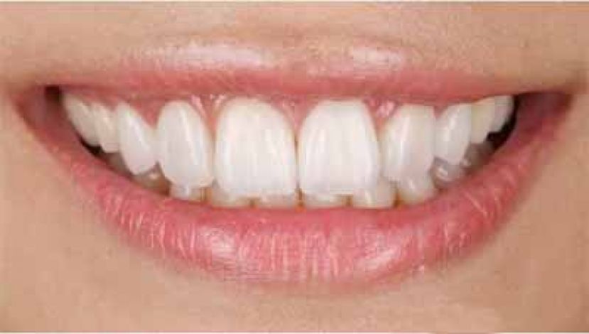 高科技数位设备＋牙科美学认证打造完美全瓷牙冠