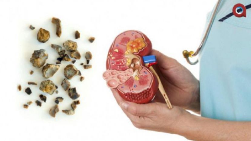 肾石塞尿管 日饮八杯水少盐减风险