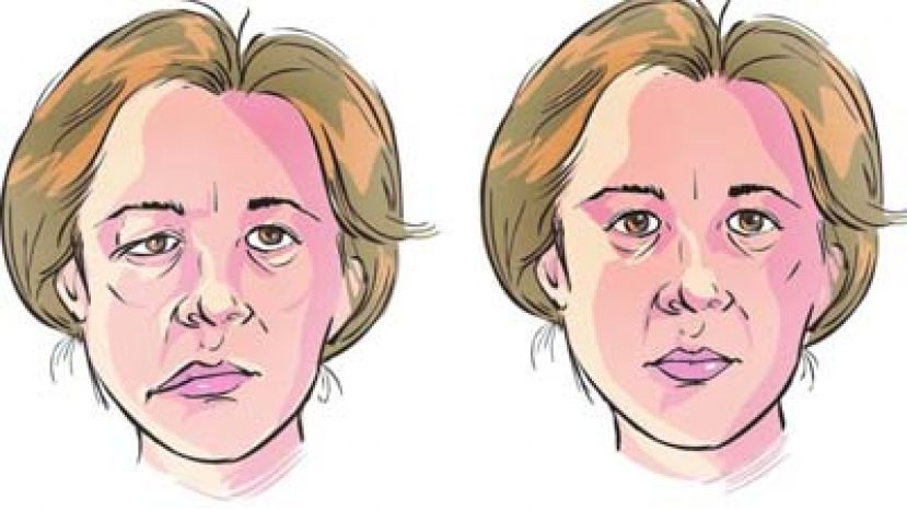 秋季易发&ldquo;面瘫&rdquo; 中医教按摩促血循
