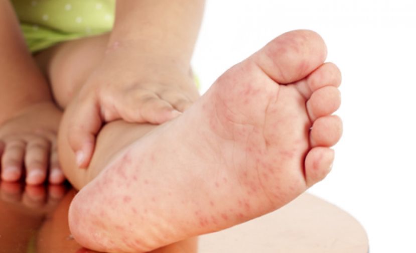 手足口病病情可轻可重 三症状是警讯