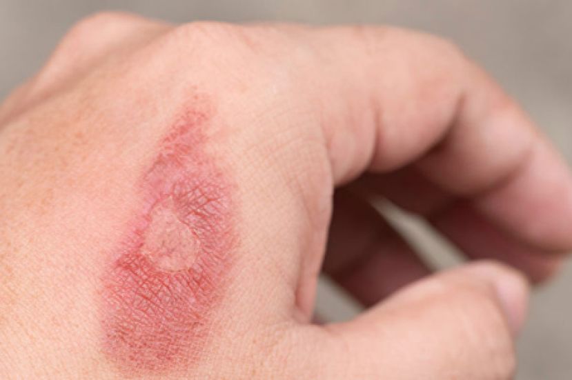 烫伤千万别用冰敷 关键三步正确急救