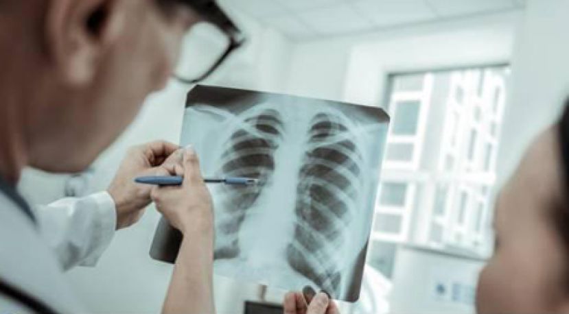 肋骨骨折爆痛及早手术愈后佳