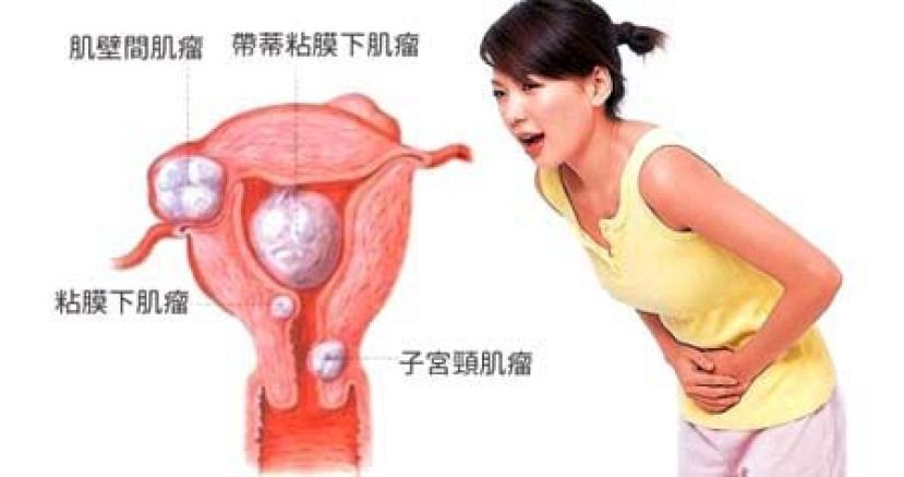 子宫肌瘤缩小 好孕宝宝来报到