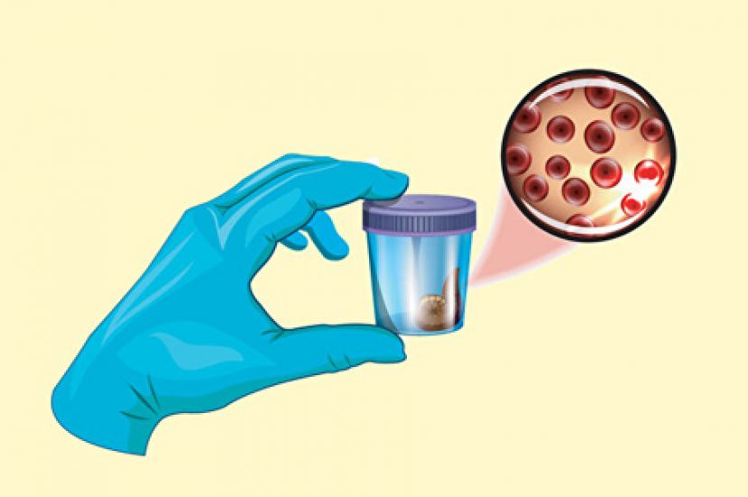 确保肠癌不要来 粪便潜血两年筛