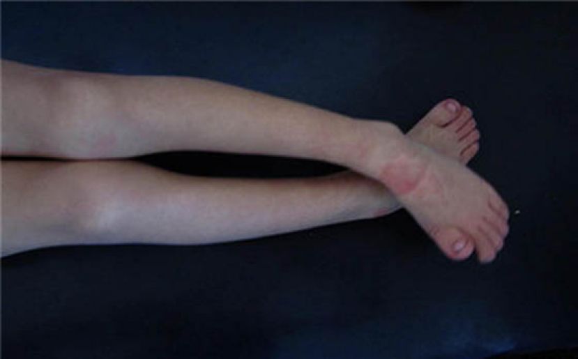 患上小儿麻痹症，将四肢无力(示意图)。